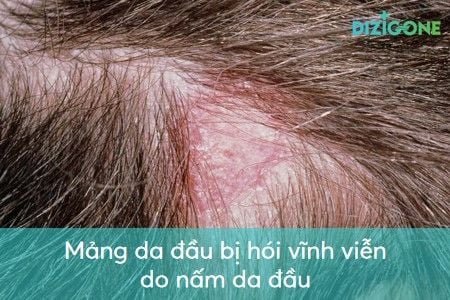Những dấu hiệu cho thấy tóc bạn bị dị ứng với sáp vuốt tóc